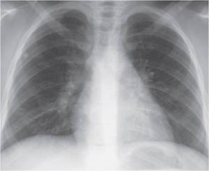 Calcified Nodules.Curry