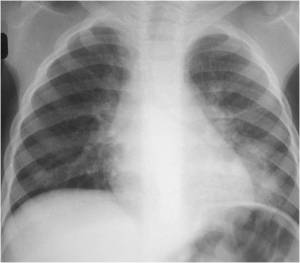 Primary LLL Infiltrate